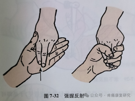 叩诊锤的怎么用康复必备：41个常见的神经反射检查_https://www.jmylbn.com_新闻资讯_第31张