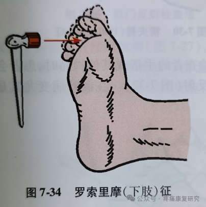 叩诊锤的怎么用康复必备：41个常见的神经反射检查_https://www.jmylbn.com_新闻资讯_第33张