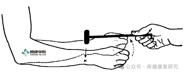 叩诊锤的怎么用康复必备：41个常见的神经反射检查_https://www.jmylbn.com_新闻资讯_第7张