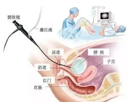 b膀胱镜为什么消毒膀胱镜是什么？需不需要做膀胱镜检查？_https://www.jmylbn.com_新闻资讯_第5张