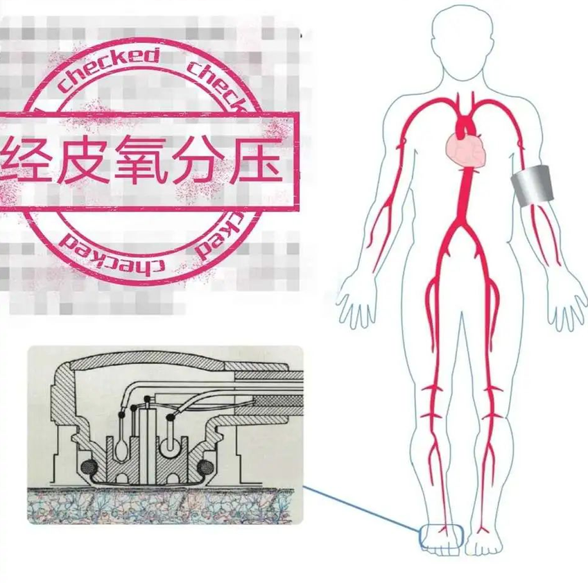 什么是经皮氧分压健康科普丨糖尿病足防治新利器---经皮氧分压检测_https://www.jmylbn.com_新闻资讯_第3张