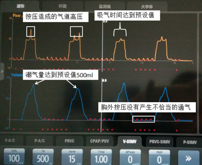 容控模式怎么表示全院都是呼吸科？那这个「呼吸基本功」你需要掌握_https://www.jmylbn.com_新闻资讯_第7张