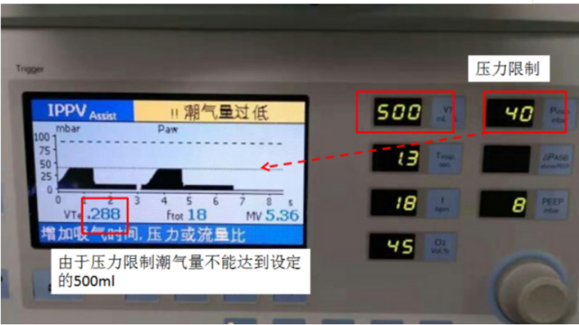 容控模式怎么表示全院都是呼吸科？那这个「呼吸基本功」你需要掌握_https://www.jmylbn.com_新闻资讯_第4张