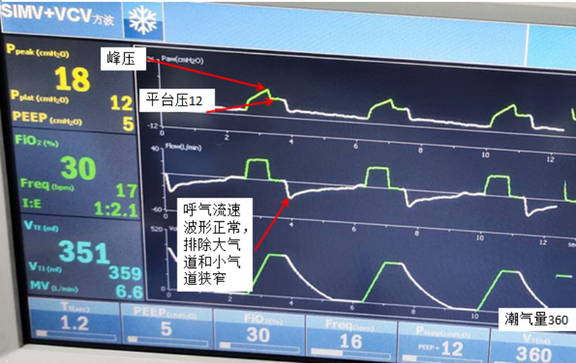 容控模式怎么表示全院都是呼吸科？那这个「呼吸基本功」你需要掌握_https://www.jmylbn.com_新闻资讯_第5张