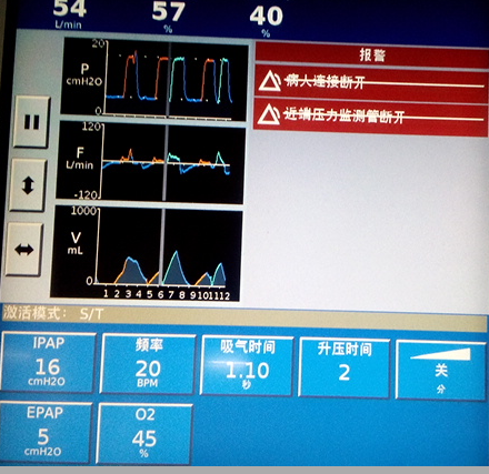 呼吸机怎么换氧气患者使用呼吸机后血氧为何更低了？一文解答_https://www.jmylbn.com_新闻资讯_第6张