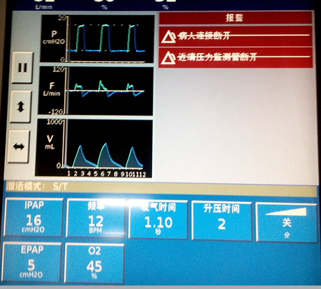 呼吸机怎么换氧气患者使用呼吸机后血氧为何更低了？一文解答_https://www.jmylbn.com_新闻资讯_第7张