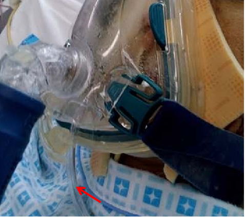 制氧机面罩怎么用普通面罩和储氧面罩有何区别？关于「面罩和氧疗」的 5 问 5 答_https://www.jmylbn.com_新闻资讯_第5张