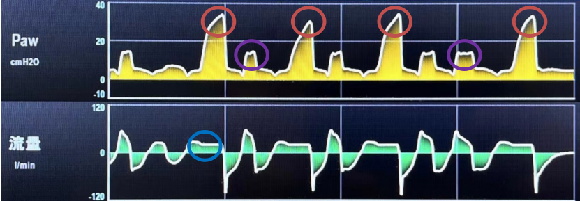 为什么成人呼吸机用容控呼吸机保姆级入门教程 2：三种基础模式的组合 — SIMV_https://www.jmylbn.com_新闻资讯_第6张