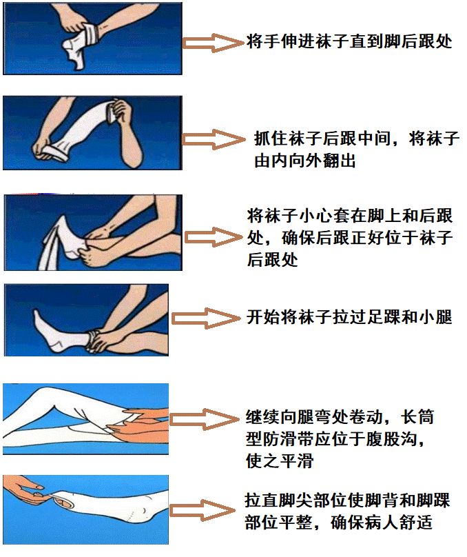 医用弹力袜用什么洗科普新知 ｜ 别误会，它只是看着很像丝袜......_https://www.jmylbn.com_新闻资讯_第9张