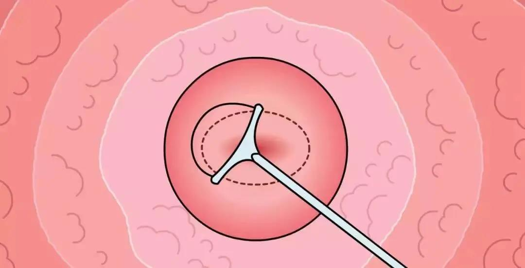 电切环怎么用【精彩必读】子宫颈环电切术（LEEP刀）_https://www.jmylbn.com_新闻资讯_第4张