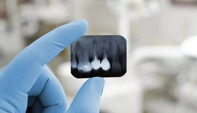 口腔设备有什么一文读懂 ｜ 口腔影像设备大科普，哪种才是最适合你的选择？_https://www.jmylbn.com_新闻资讯_第6张