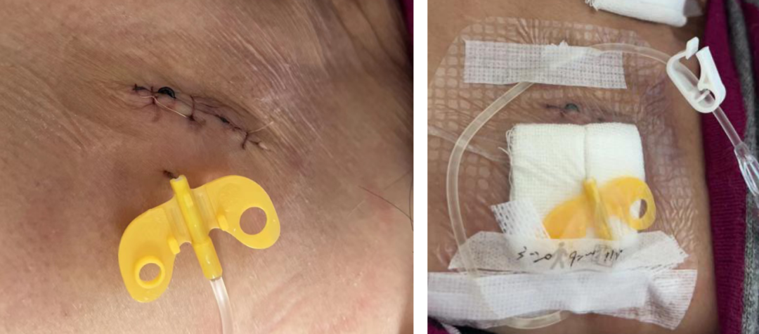 为什么输液要盖块纱布输液港穿刺点什么时候暴露？什么时候覆盖？看完这两个案例你就明白了_https://www.jmylbn.com_新闻资讯_第13张