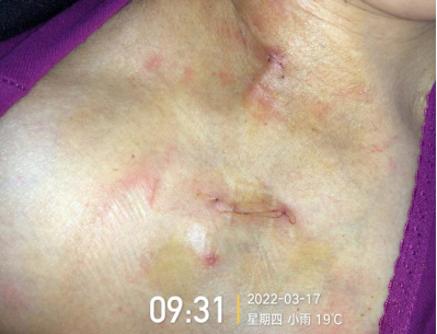 为什么输液要盖块纱布输液港穿刺点什么时候暴露？什么时候覆盖？看完这两个案例你就明白了_https://www.jmylbn.com_新闻资讯_第9张