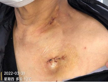 为什么输液要盖块纱布输液港穿刺点什么时候暴露？什么时候覆盖？看完这两个案例你就明白了_https://www.jmylbn.com_新闻资讯_第16张