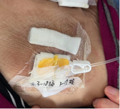 为什么输液要盖块纱布输液港穿刺点什么时候暴露？什么时候覆盖？看完这两个案例你就明白了_https://www.jmylbn.com_新闻资讯_第12张