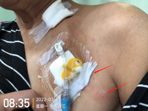 为什么输液要盖块纱布输液港穿刺点什么时候暴露？什么时候覆盖？看完这两个案例你就明白了_https://www.jmylbn.com_新闻资讯_第14张