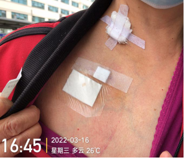 为什么输液要盖块纱布输液港穿刺点什么时候暴露？什么时候覆盖？看完这两个案例你就明白了_https://www.jmylbn.com_新闻资讯_第8张