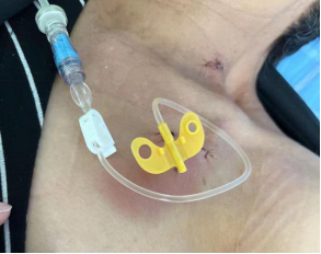 为什么输液要盖块纱布输液港穿刺点什么时候暴露？什么时候覆盖？看完这两个案例你就明白了_https://www.jmylbn.com_新闻资讯_第10张