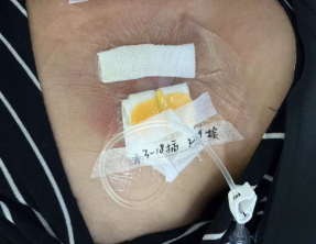 为什么输液要盖块纱布输液港穿刺点什么时候暴露？什么时候覆盖？看完这两个案例你就明白了_https://www.jmylbn.com_新闻资讯_第11张