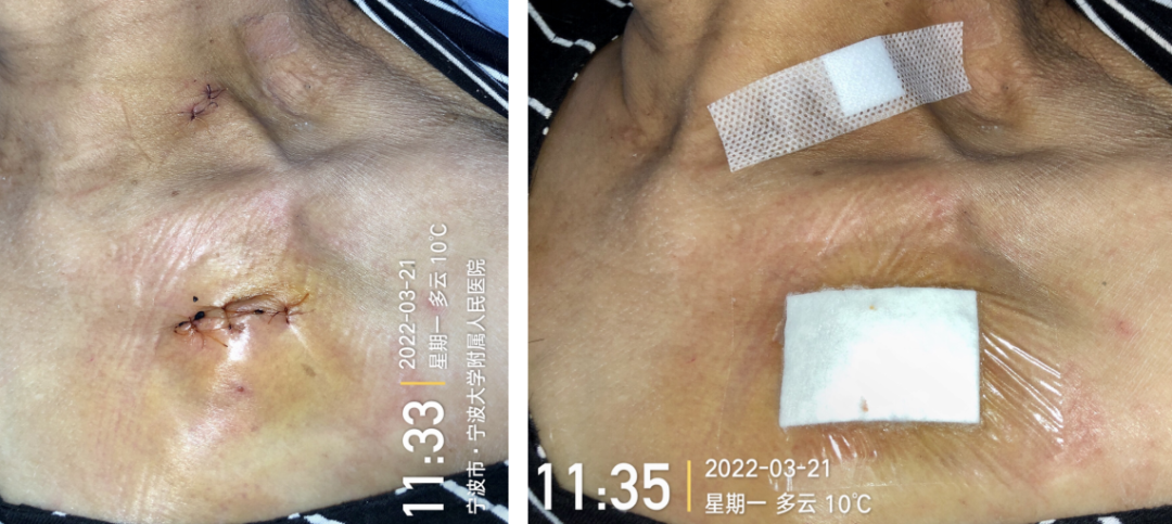 为什么输液要盖块纱布输液港穿刺点什么时候暴露？什么时候覆盖？看完这两个案例你就明白了_https://www.jmylbn.com_新闻资讯_第15张