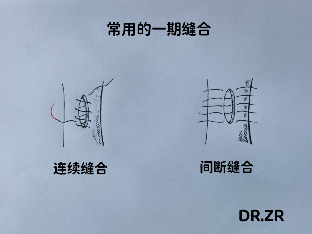 什么叫取石钳ERCP？切开取石？胆总管结石最佳治疗手段居然是这个……-上海聚慕医疗器械有限公司