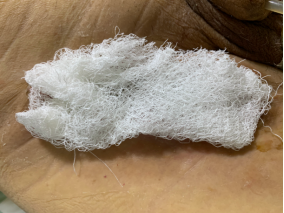 vsd引流器怎么连接如何自己制作负压引流装置？这里有一份图文教程送给你_https://www.jmylbn.com_新闻资讯_第2张