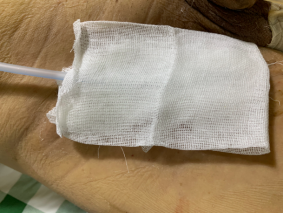 vsd引流器怎么连接如何自己制作负压引流装置？这里有一份图文教程送给你_https://www.jmylbn.com_新闻资讯_第3张