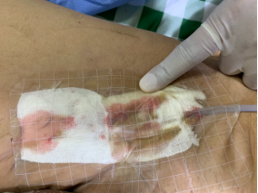 vsd引流器怎么连接如何自己制作负压引流装置？这里有一份图文教程送给你_https://www.jmylbn.com_新闻资讯_第5张