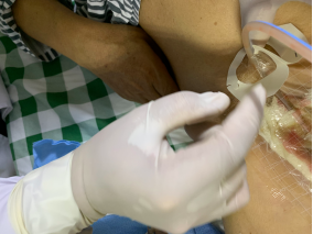 vsd引流器怎么连接如何自己制作负压引流装置？这里有一份图文教程送给你_https://www.jmylbn.com_新闻资讯_第6张