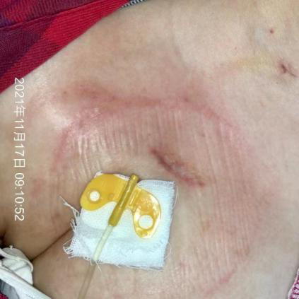 为什么输液管要粘上面输液港想要长久使用，敷料粘贴有学问_https://www.jmylbn.com_新闻资讯_第2张