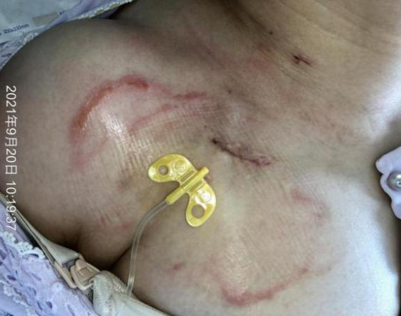 为什么输液管要粘上面输液港想要长久使用，敷料粘贴有学问_https://www.jmylbn.com_新闻资讯_第6张