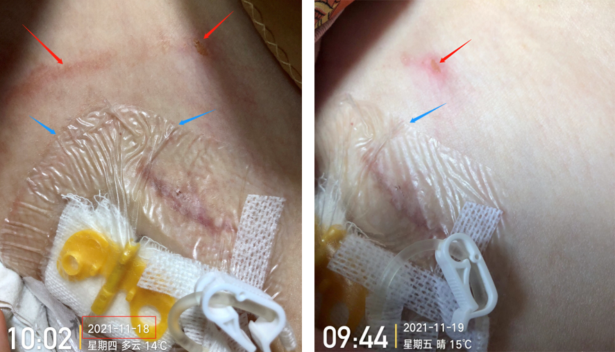 为什么输液管要粘上面输液港想要长久使用，敷料粘贴有学问_https://www.jmylbn.com_新闻资讯_第5张