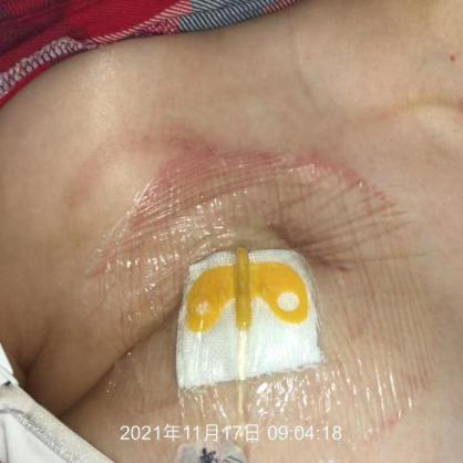 为什么输液管要粘上面输液港想要长久使用，敷料粘贴有学问_https://www.jmylbn.com_新闻资讯_第1张