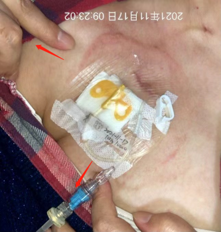 为什么输液管要粘上面输液港想要长久使用，敷料粘贴有学问_https://www.jmylbn.com_新闻资讯_第4张