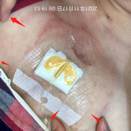 为什么输液管要粘上面输液港想要长久使用，敷料粘贴有学问_https://www.jmylbn.com_新闻资讯_第3张