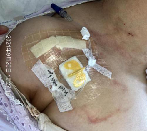 为什么输液管要粘上面输液港想要长久使用，敷料粘贴有学问_https://www.jmylbn.com_新闻资讯_第7张