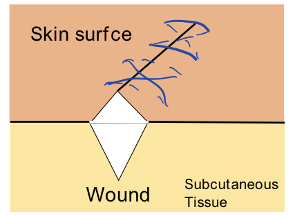缝伤口怎么打结急诊外科必备技能——清创缝合术_https://www.jmylbn.com_新闻资讯_第8张