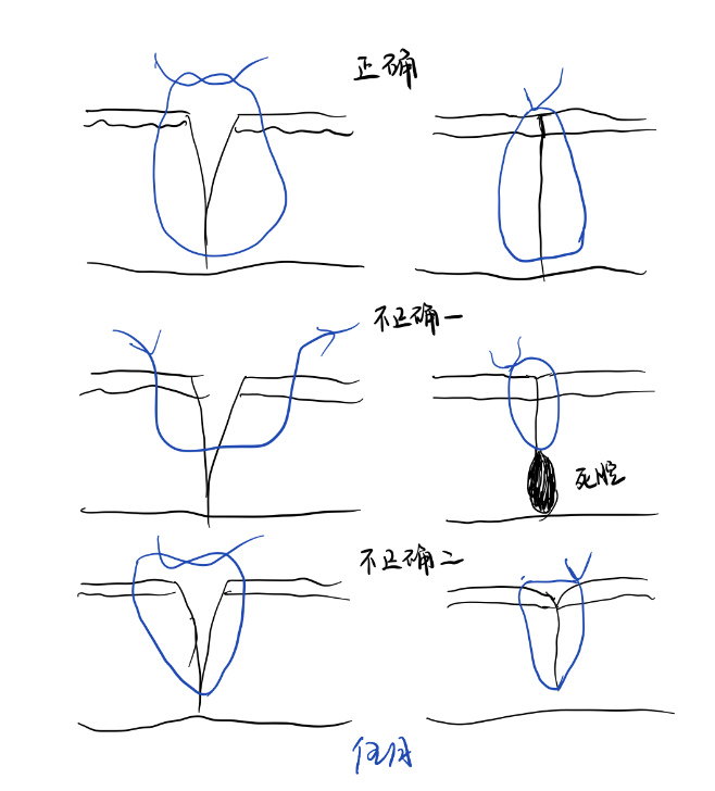 缝伤口怎么打结急诊外科必备技能——清创缝合术_https://www.jmylbn.com_新闻资讯_第7张
