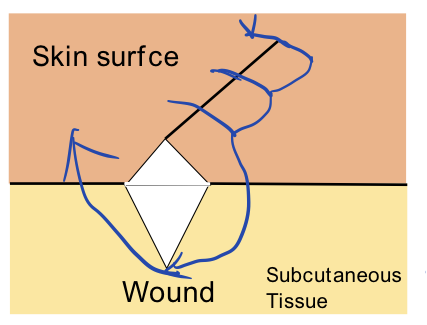 缝伤口怎么打结急诊外科必备技能——清创缝合术_https://www.jmylbn.com_新闻资讯_第10张