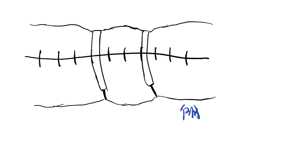 缝伤口怎么打结急诊外科必备技能——清创缝合术_https://www.jmylbn.com_新闻资讯_第16张