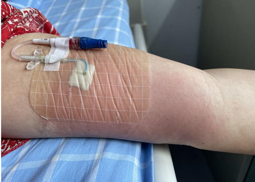 什么是功能性敷料​每天都在换药，你知道如何选择伤口敷料吗？_https://www.jmylbn.com_新闻资讯_第17张