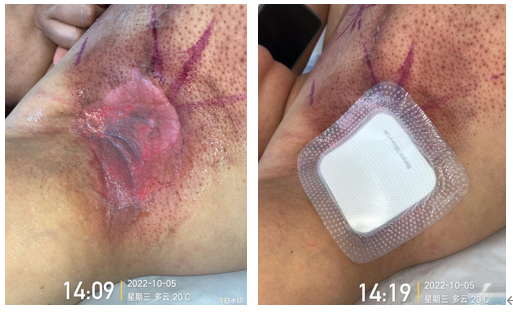 什么是功能性敷料​每天都在换药，你知道如何选择伤口敷料吗？_https://www.jmylbn.com_新闻资讯_第20张