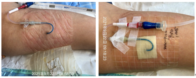 什么是功能性敷料​每天都在换药，你知道如何选择伤口敷料吗？_https://www.jmylbn.com_新闻资讯_第18张