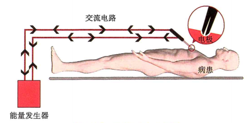 为什么要手术电刀笔手术室笔记：单极、双极、超声刀、氩气刀对比，收好这份「兵器谱」_https://www.jmylbn.com_新闻资讯_第4张