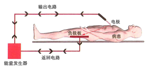 为什么要手术电刀笔手术室笔记：单极、双极、超声刀、氩气刀对比，收好这份「兵器谱」_https://www.jmylbn.com_新闻资讯_第2张