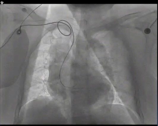 早读 | 冠状动脉开口异常造影技巧