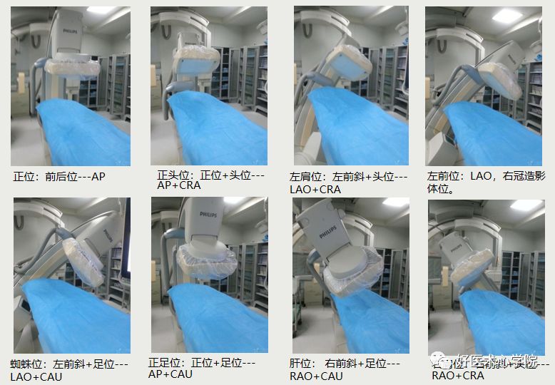 造影导丝是什么珍藏 冠脉造影从流程到诊断，基础必备！_https://www.jmylbn.com_新闻资讯_第41张