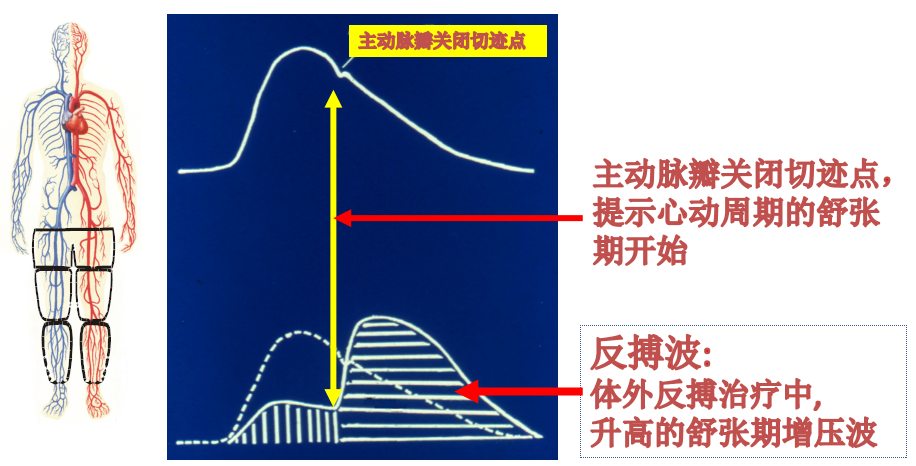 体外反搏在心脏康复中的应用