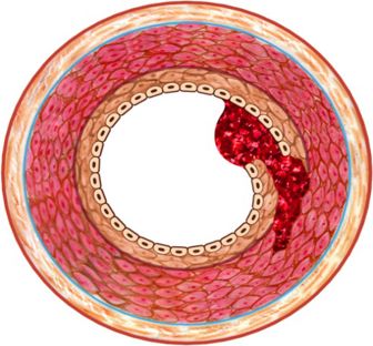 造影导丝是什么珍藏 冠脉造影从流程到诊断，基础必备！_https://www.jmylbn.com_新闻资讯_第85张