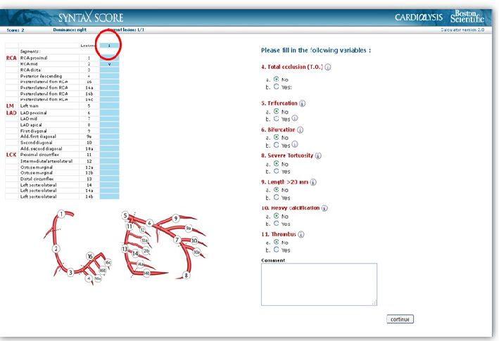 造影导丝是什么珍藏 冠脉造影从流程到诊断，基础必备！_https://www.jmylbn.com_新闻资讯_第103张
